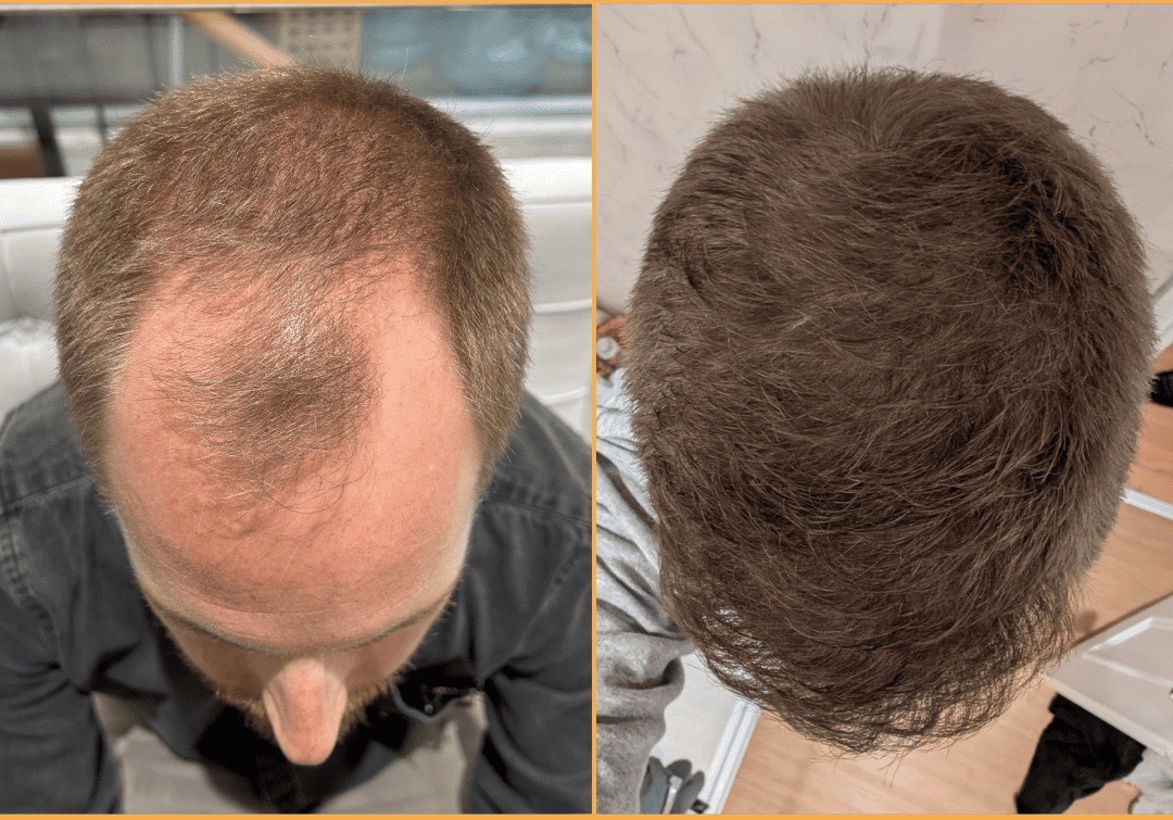 Aerial before and after view of an FUE hair transplant