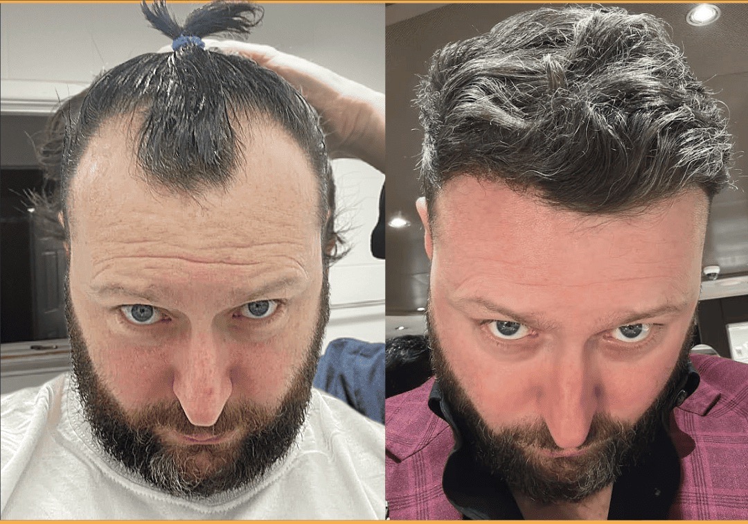 Before and after FUE hair transplant restoring a receding hairline