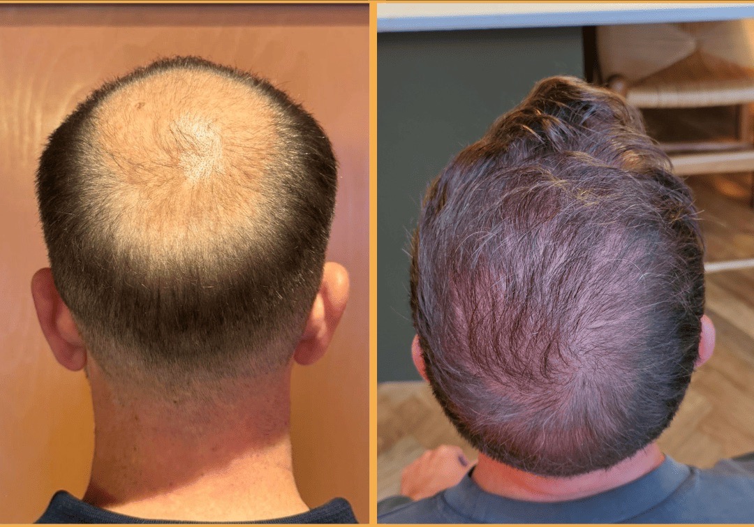 Before and after FUE hair transplant restoring the crown