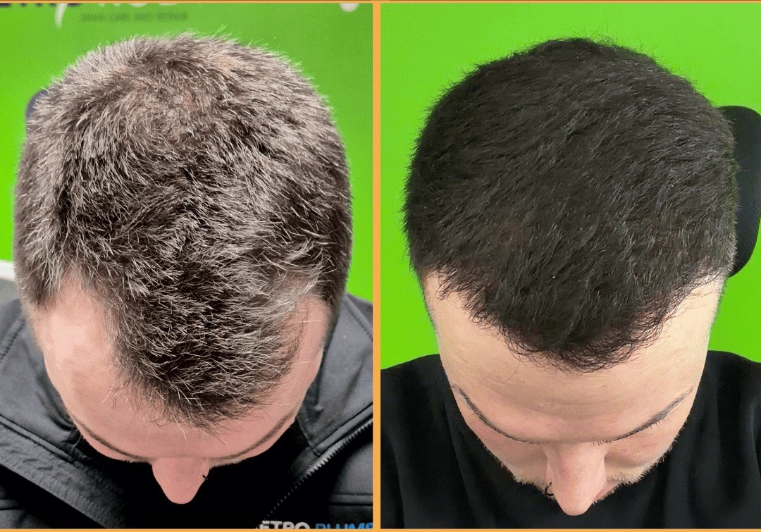 Before and after FUE hair transplant for thinning hair