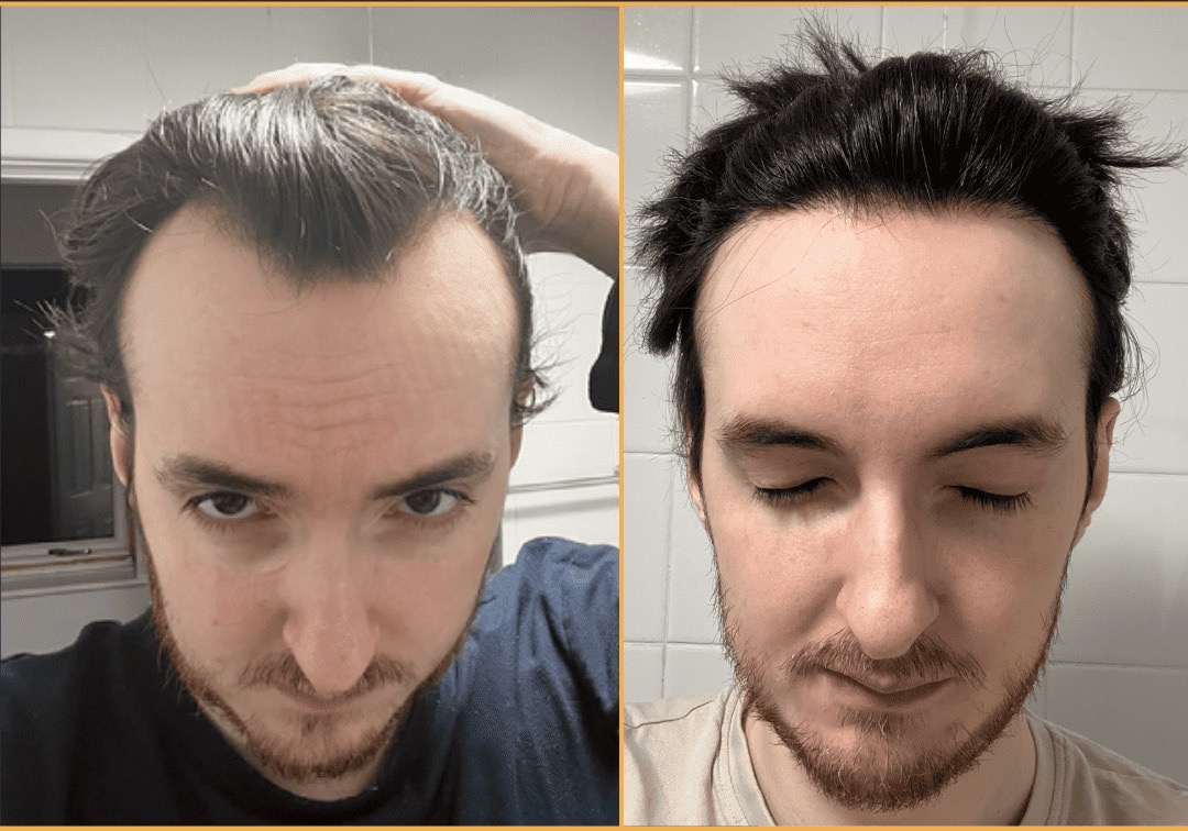 Before and after FUE hair transplant restoring the hairline