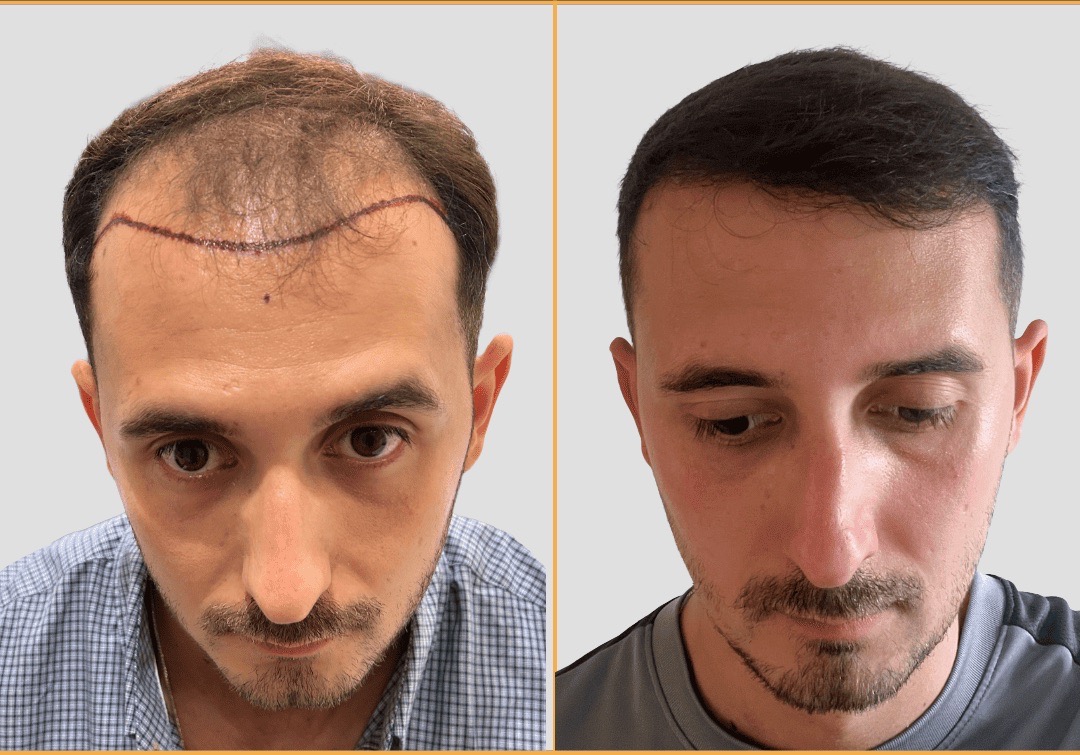 Before and after FUE hair transplant restoring the frontal hairline